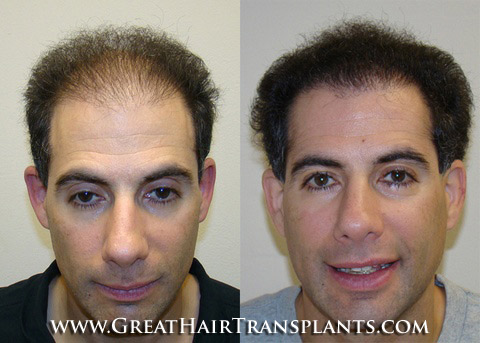 hair transplant