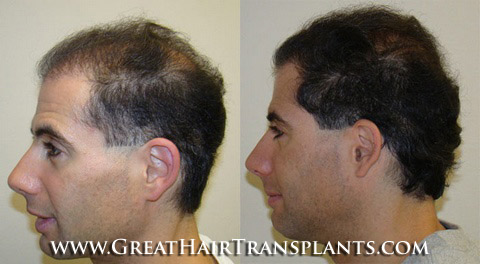 affordable hair transplants