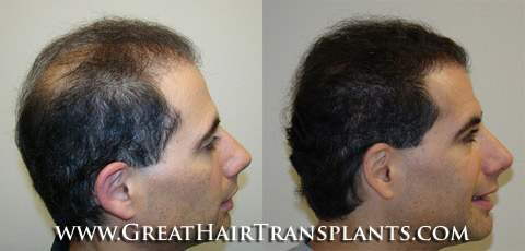 hair transplants