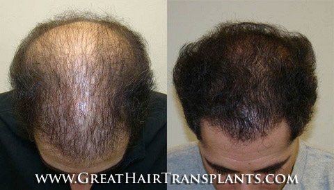 hair transplants