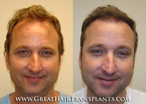 hair transplants cost