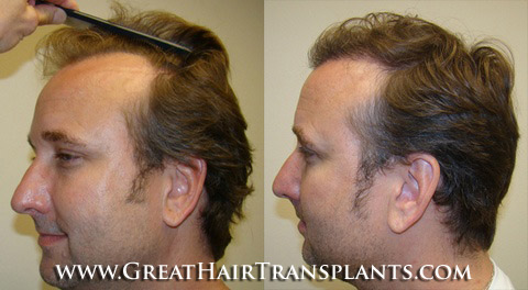 hair transplant