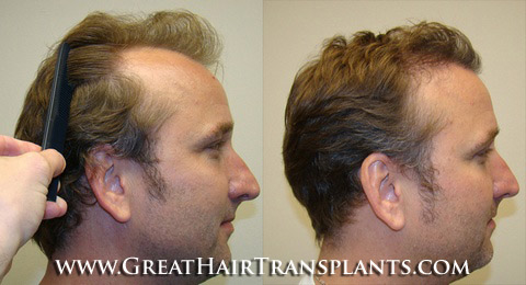 hair transplant