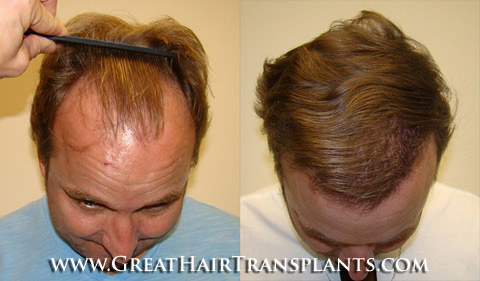 hair transplants cost