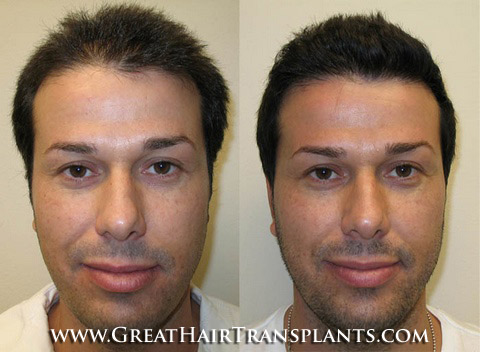 affordable hair transplants