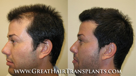 hair restoration