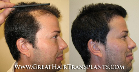 low cost hair transplants