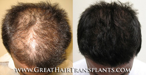 hair transplant cost