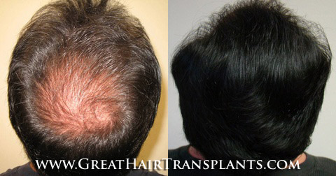 low cost hair transplant