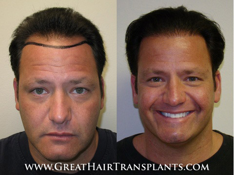 hair implants