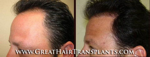 low cost hair transplant