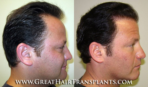 hair transplant cost