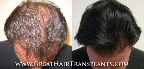 affordable hair transplants