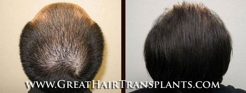 hair transplant