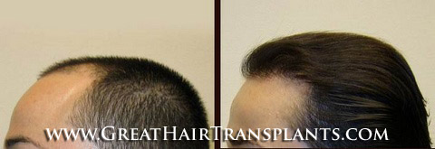 hair implant