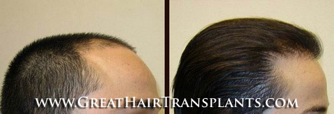 affordable hair transplants