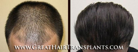 hair transplants