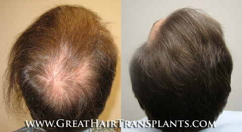 hair restoration