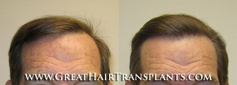 hair transplants