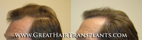 hair transplant