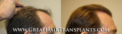 affordable hair transplants