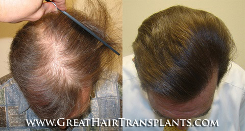 hair restoration