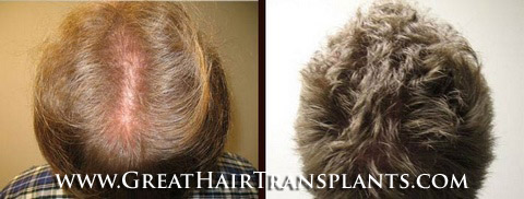 hair transplant surgery