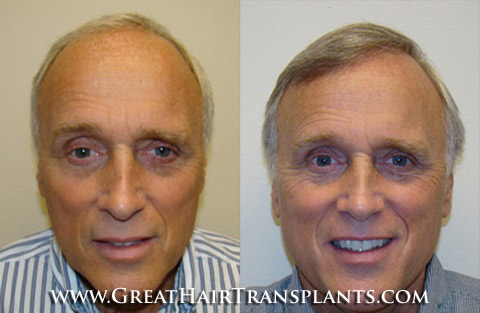 hair transplant cost