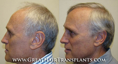 hair transplant cost