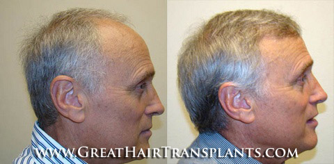 hair transplant cost