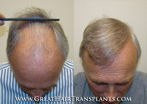 hair restoration