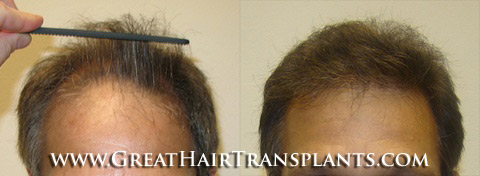 hair transplants cost