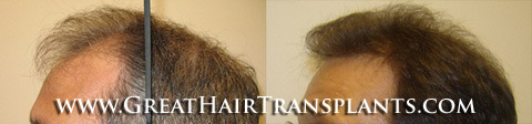 hair transplant surgery