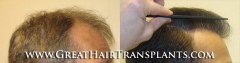 hair transplants