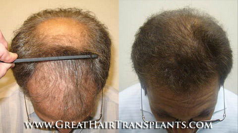 hair transplant