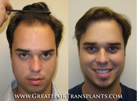 hair transplant