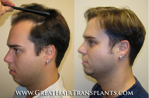 hair transplant surgery