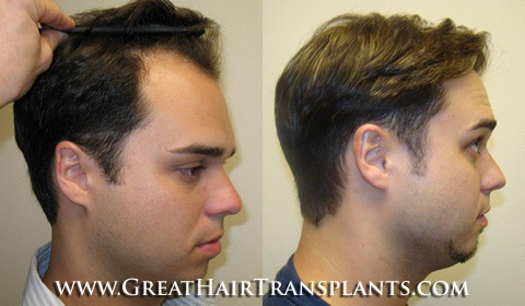 hair transplant cost