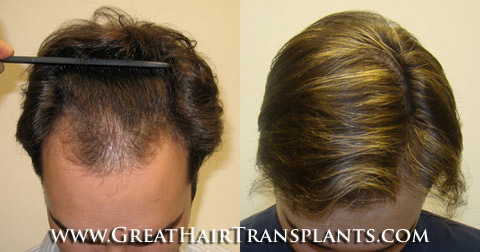 hair transplant