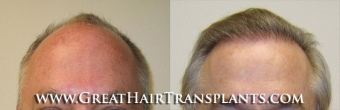 affordable hair transplants