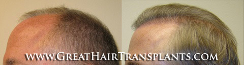 hair transplant cost