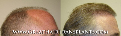 low cost hair transplant