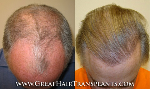 low cost hair transplants