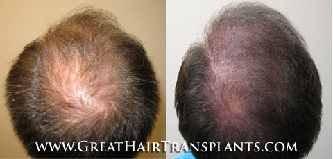 hair transplant