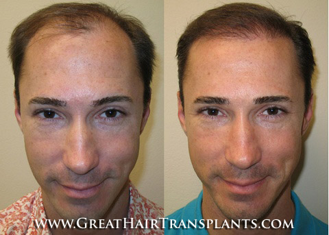 nonsurgical hair restoration