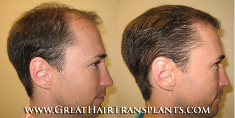 affordable hair transplants