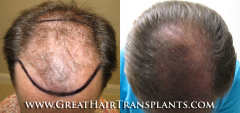 hair transplants