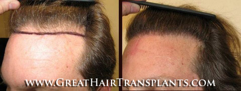 hair transplant surgery