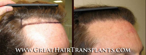 hair transplant cost