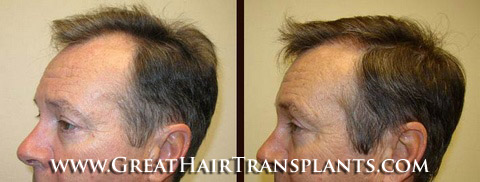 low cost hair transplants